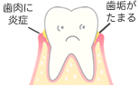 歯垢がたまる　歯肉に炎症
