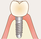 インプラントイメージ